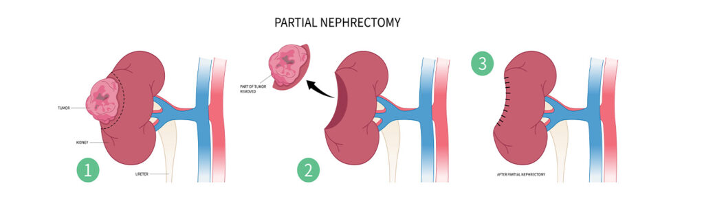 partial nephrectomy (1)
